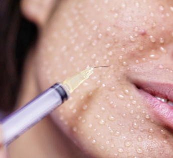 Mezoterapi ile Cilt Gençleştirme