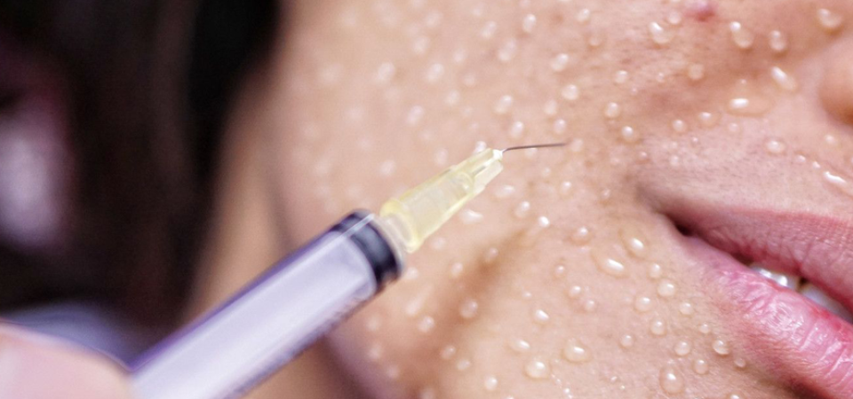 Mezoterapi ile Cilt Gençleştirme